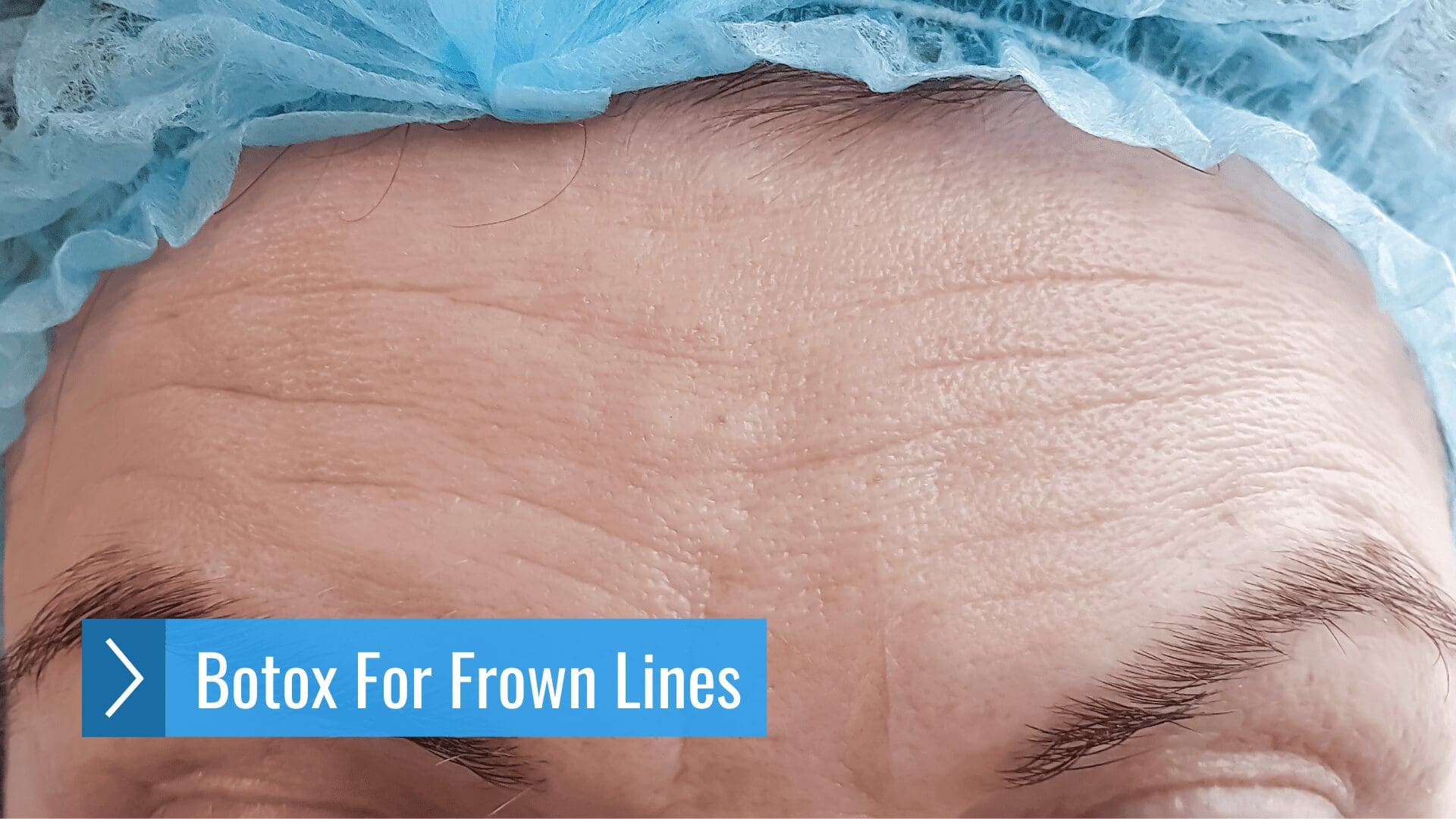 Botox For Frown Lines